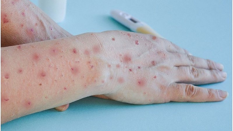 Confirmado em MS primeiro caso de var&iacute;ola dos macacos - Di&aacute;rio Corumbaense